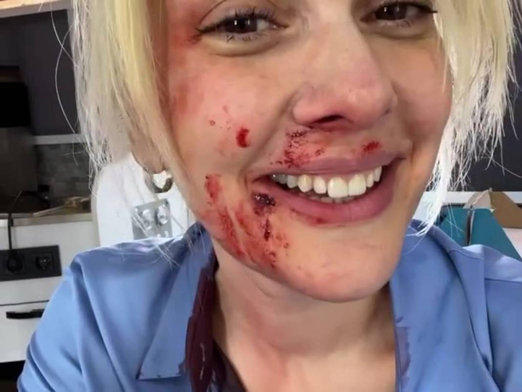 Bergüzar Korel'in kanlı paylaşımı takipçilerini korkuttu! Neden paylaştığı daha sonra ortaya çıktı 7